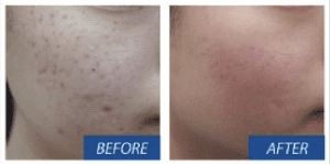 Dermapen Treatment of Acne Scars Before and After
