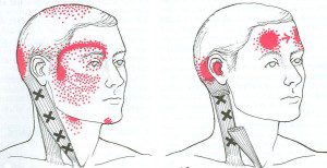 SCM Muscle Pain Pattern
