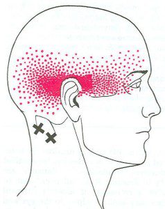 Suboccipital Muscle Pain Pattern