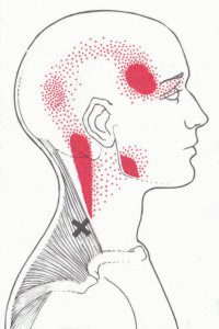 Upper Trapezius Pain Pattern