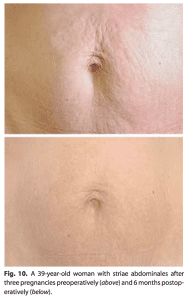 Stretch marks from pregnancy, 6 months after treatment.
