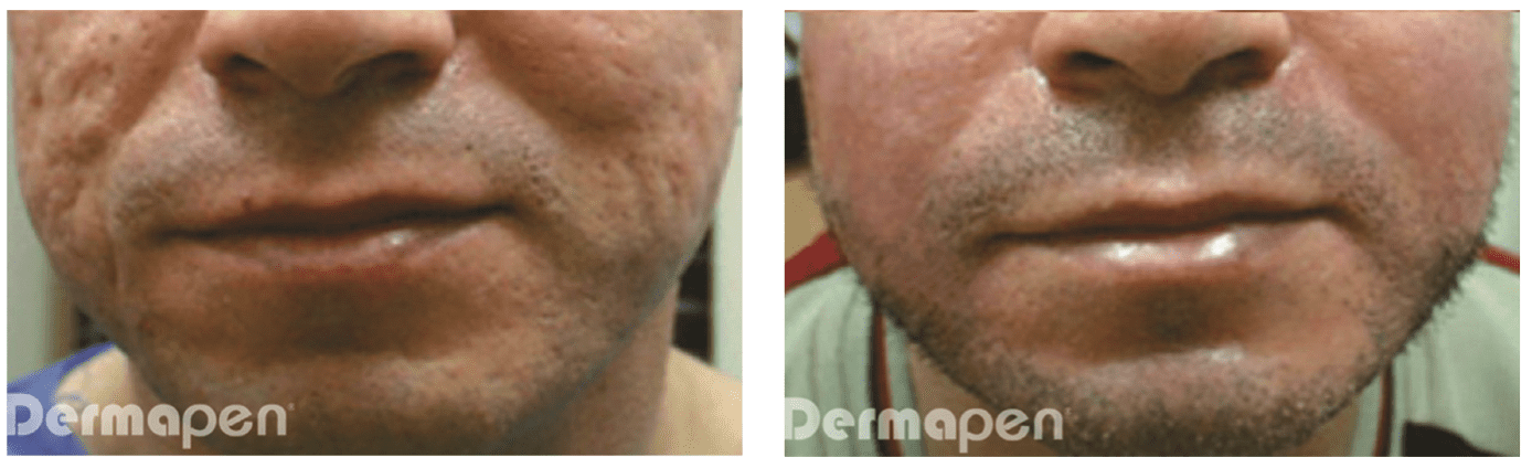 Treatment with Dermapen (TM) every 6 weeks for 6 treatments.