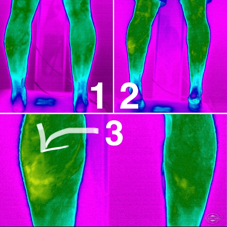 infrared imaging of injury